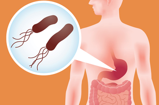 H pylori is a common bug in the human stomach